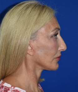 Facelift