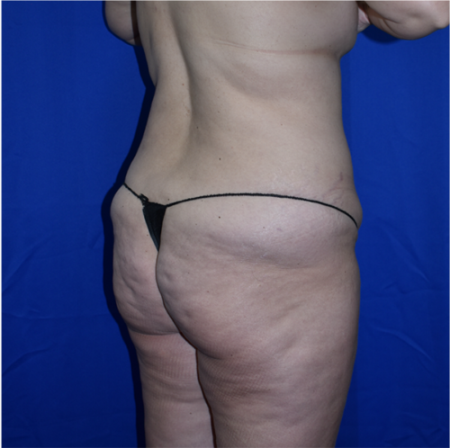 Abdominoplasty