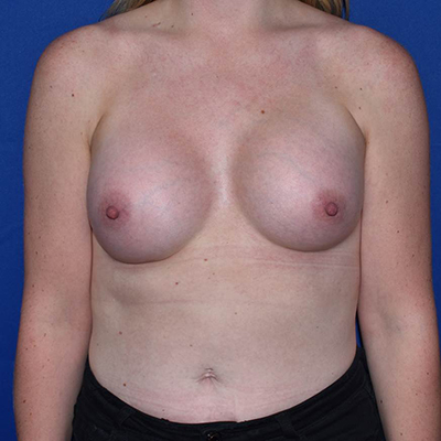 Breast Augmentation