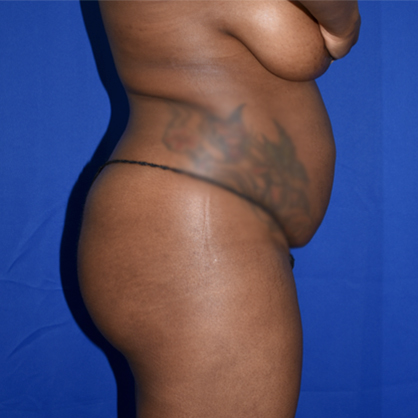 Abdominoplasty