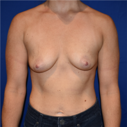 Breast Augmentation With Lift