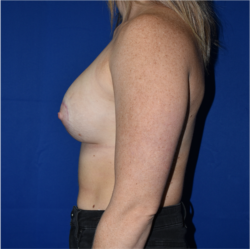 Breast Augmentation With Lift