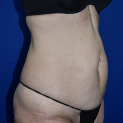 Abdominoplasty