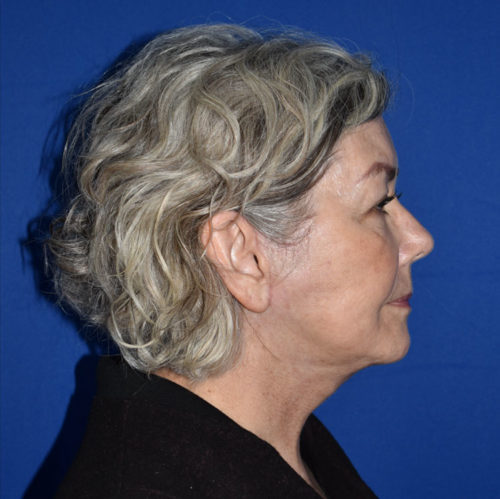 Facelift