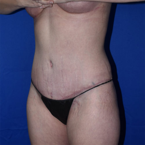 Abdominoplasty