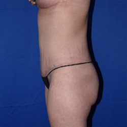 Abdominoplasty