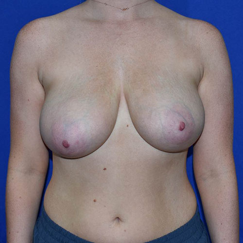 Breast Reduction