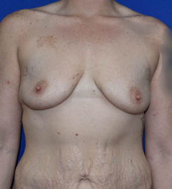 Breast Augmentation With Lift