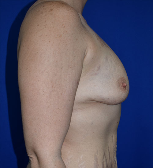 Breast Augmentation With Lift