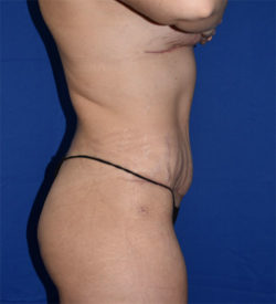 Abdominoplasty