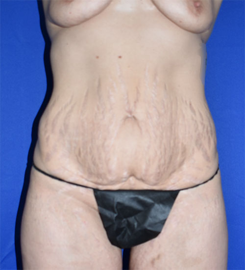 Abdominoplasty