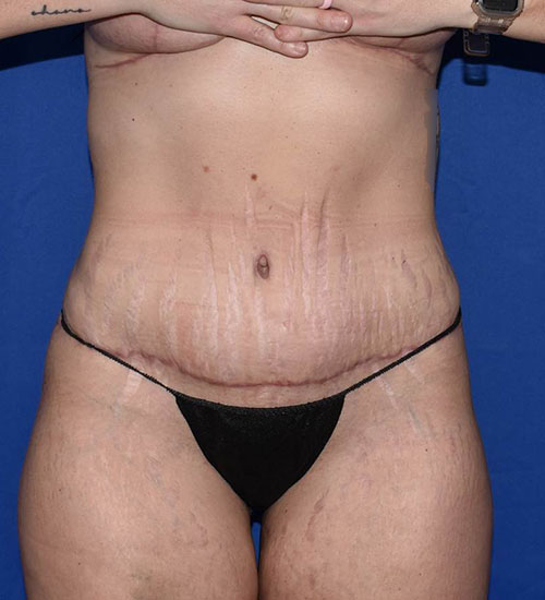 Abdominoplasty