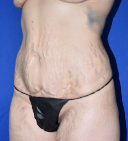 Abdominoplasty