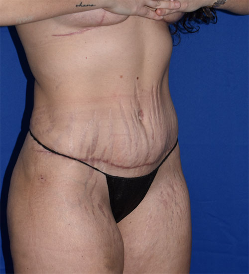 Abdominoplasty