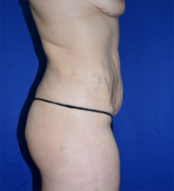 Abdominoplasty