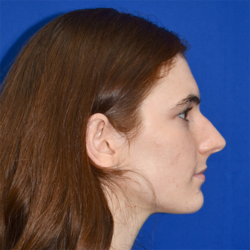 Rhinoplasty