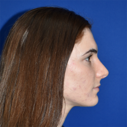 Rhinoplasty