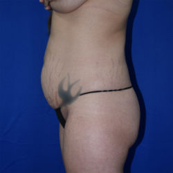 Abdominoplasty