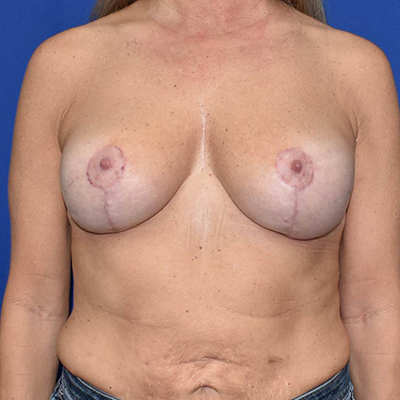 Breast Augmentation With Lift