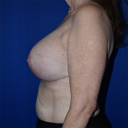 Breast Augmentation With Lift