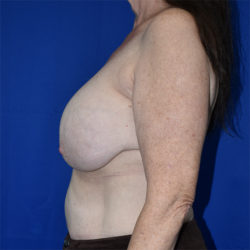 Breast Augmentation With Lift