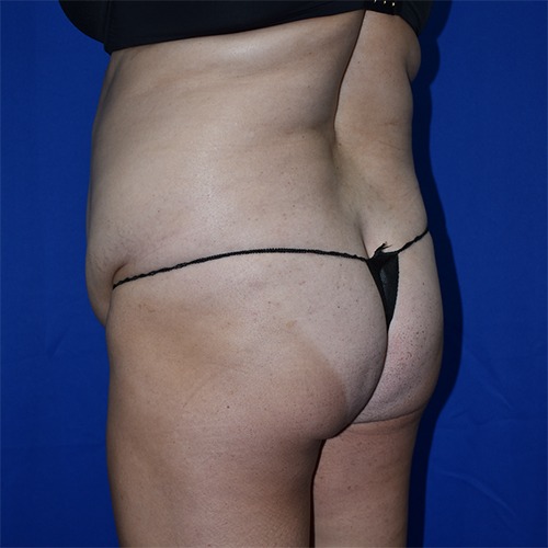 Abdominoplasty