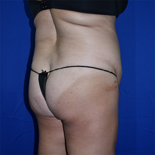 Abdominoplasty