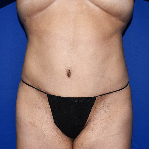 Abdominoplasty