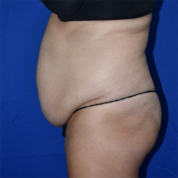 Abdominoplasty