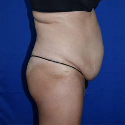 Abdominoplasty