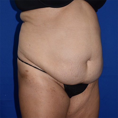 Abdominoplasty