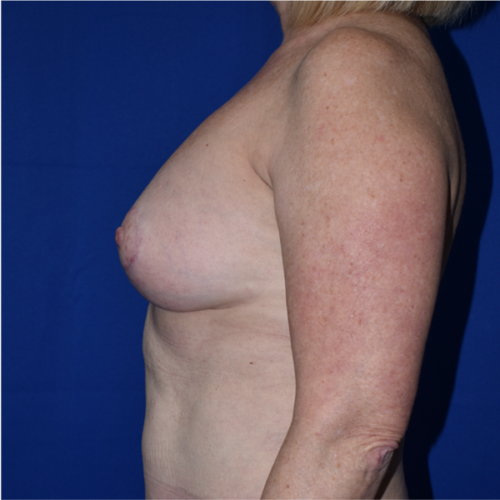 Breast Augmentation With Lift