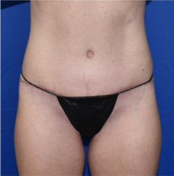 Abdominoplasty