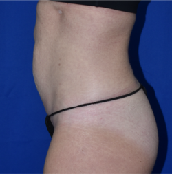 Abdominoplasty