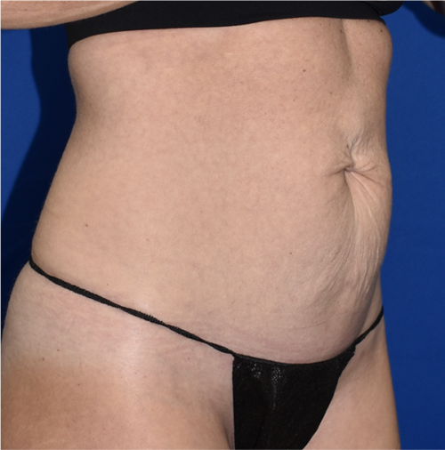 Abdominoplasty