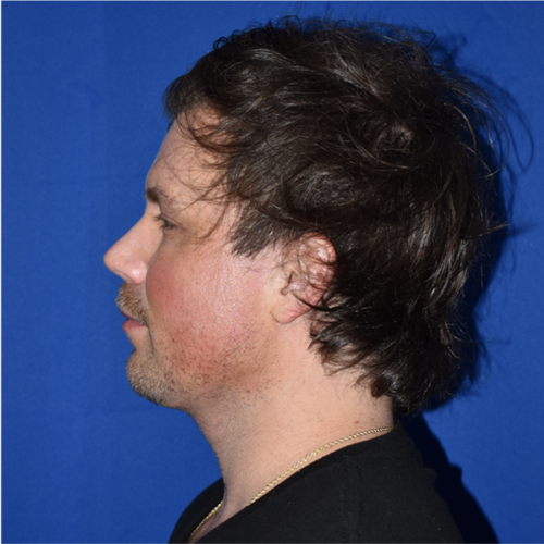 Chin Liposuction