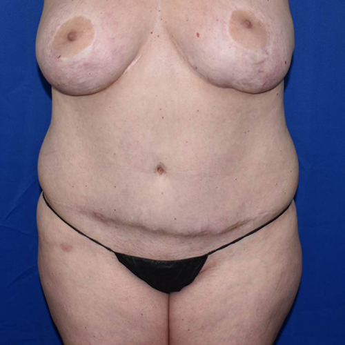 Liposuction