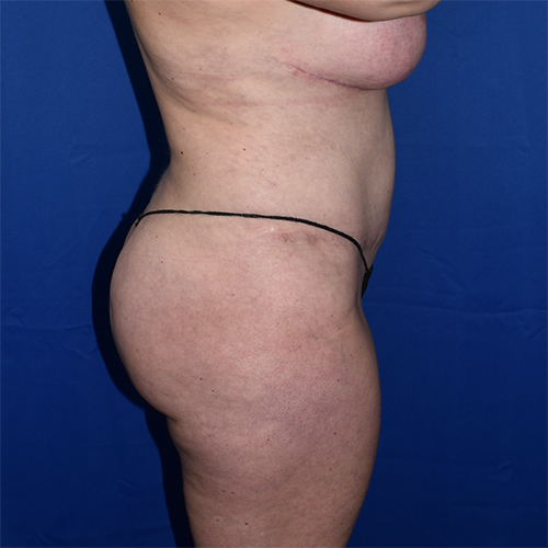 Liposuction