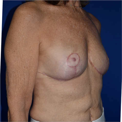 Breast Implant Removal