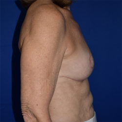 Breast Implant Removal