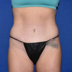 Abdominoplasty