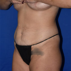 Abdominoplasty