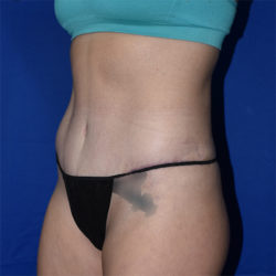 Abdominoplasty