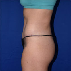 Abdominoplasty