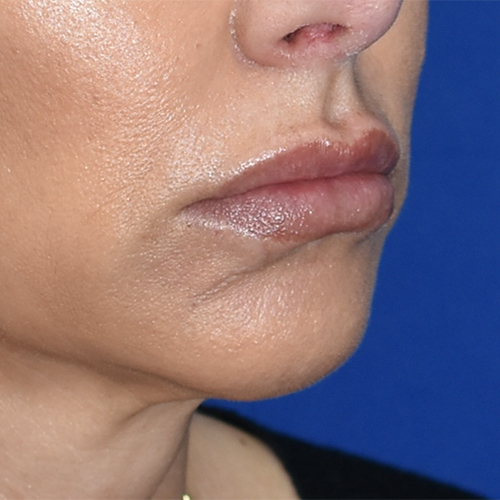 Lip Augmentation/Lip Implant