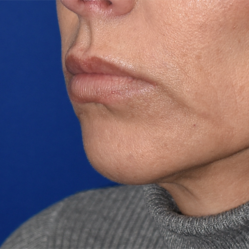 Lip Augmentation/Lip Implant