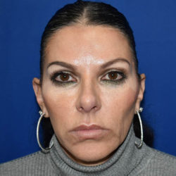Lip Augmentation/Lip Implant