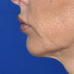 Lip Augmentation/Lip Implant