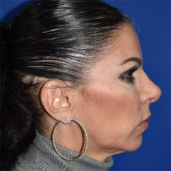 Lip Augmentation/Lip Implant