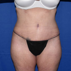 Abdominoplasty